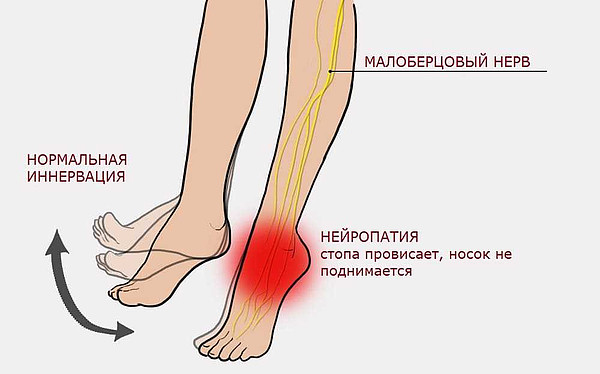 provisanie-stopy-priznak-nejropatii-malobercovogo-nerva. 